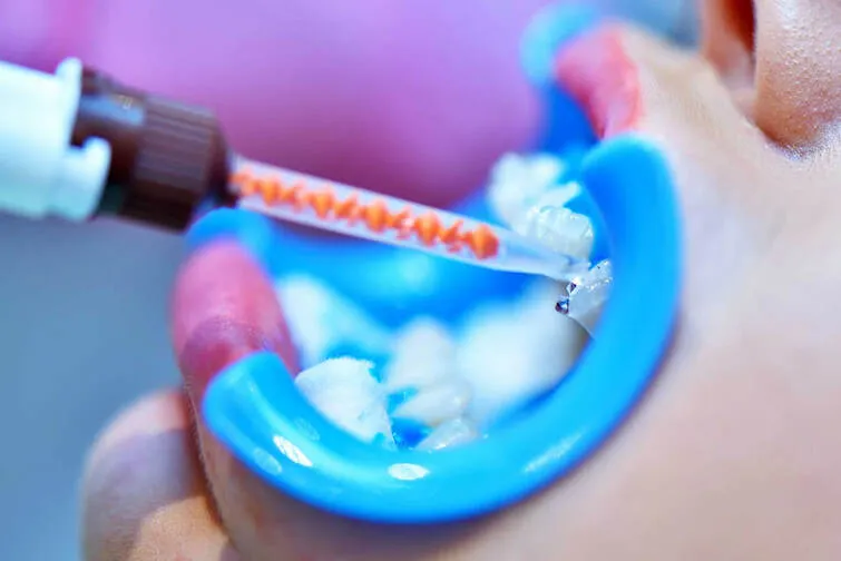 Bleaching-Gel wird auf die Zähne aufgetragen