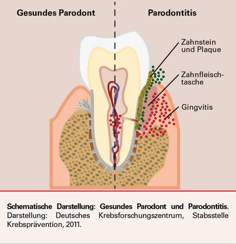 Schemazeichnung: gesundes Parodont und Parodontitis