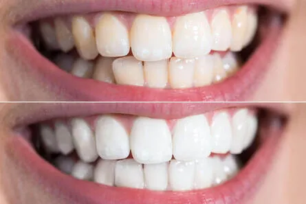 Vergleich der Zahnfarbe vor und nach dem Bleaching