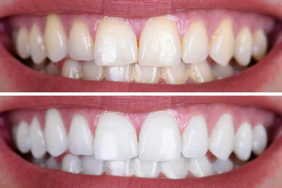 Vergleich eines Lachens vor und nach Dentalhygiene und Bleaching