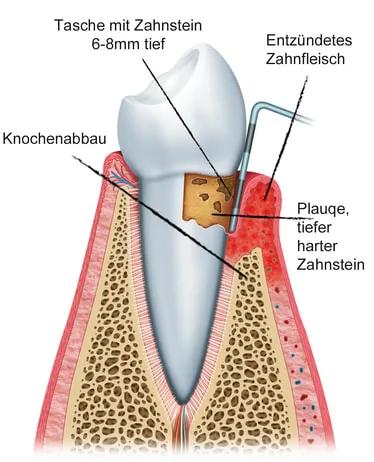Schemazeichnung eines Zahns mit beginnender Parodontitis