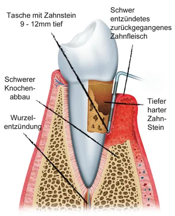 Schemazeichnung eines Zahns mit schwerer Parodontitis